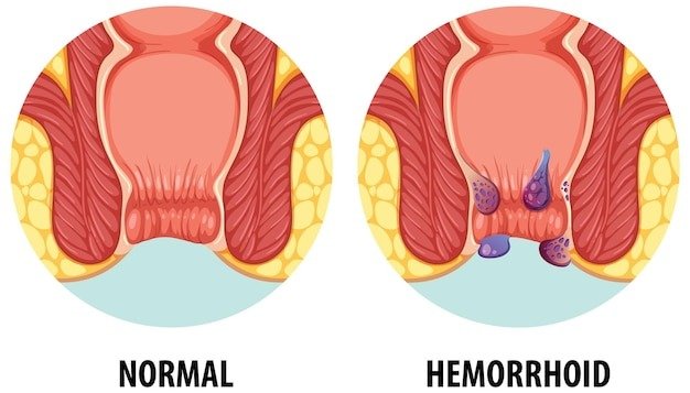 Best Piles Surgery in West Delhi