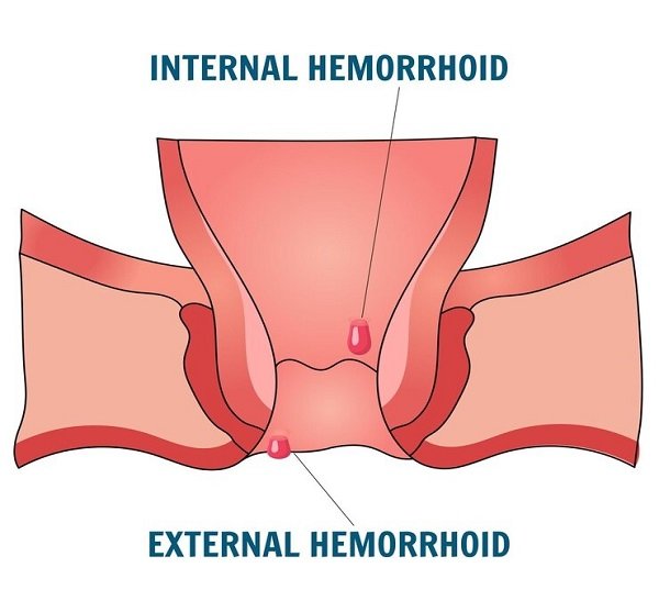 Best haemorrhoids surgery in West Delhi