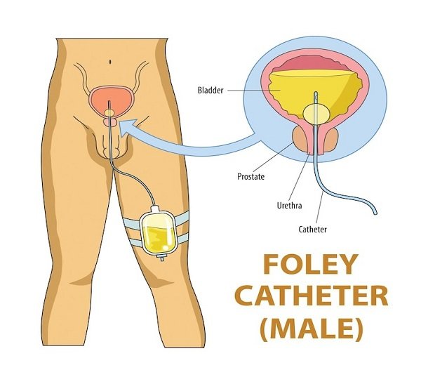 Circumcision Surgery in Delhi