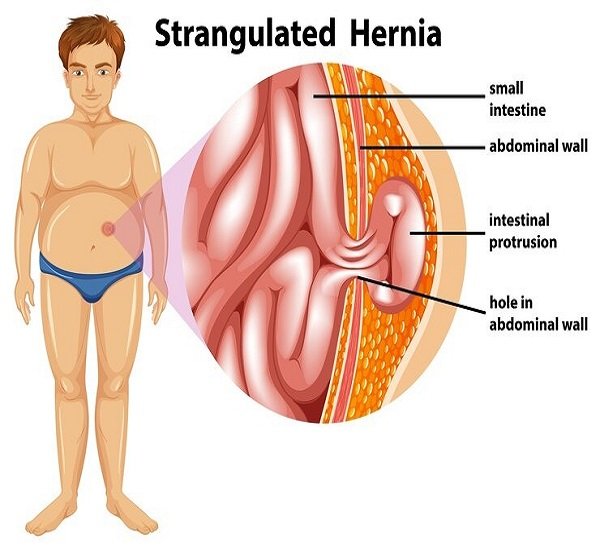 Hernia Surgery in Paschim Vihar