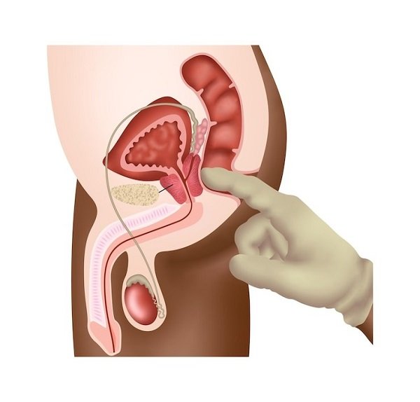 Varicocele Surgery in Paschim Vihar