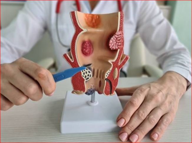 Best Hemorrhoids Surgery in West Delhi