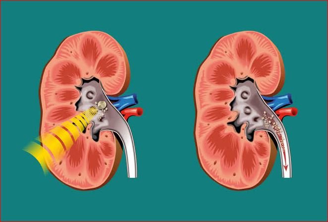 Laser Treatment for Kidney Stones
